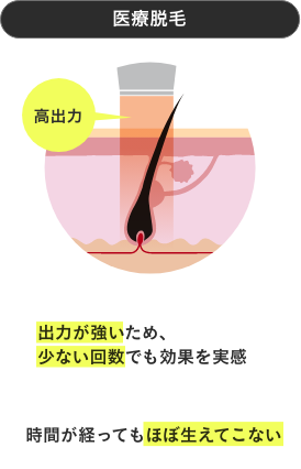 メンズエミナル脱毛 医療脱毛