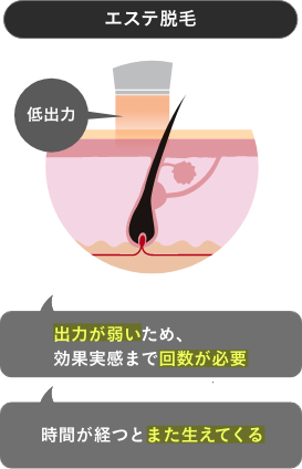 メンズエミナル脱毛サロンとの違い